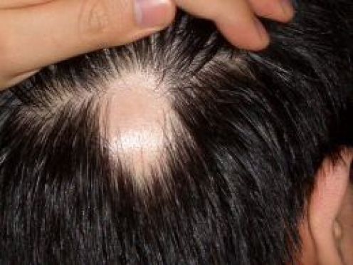 Alopeetsia on