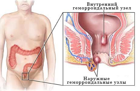 Hemorroidide esinemissagedus
