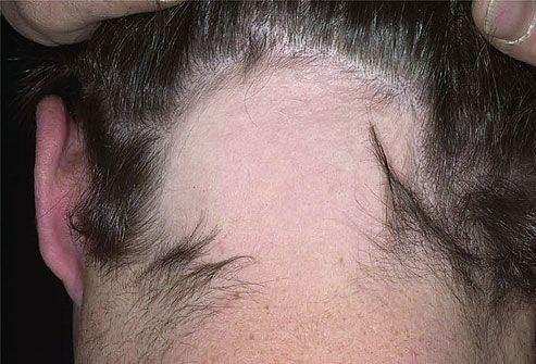 Alopeetsia on