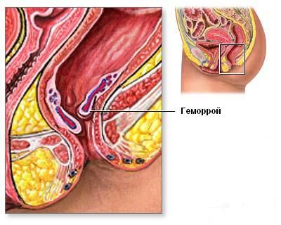 Valikud hemorroidide raviks kodus on