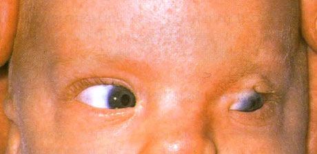Fraseri sündroom.  Vasakpoolse silma kahjustamata krüptoflastos.