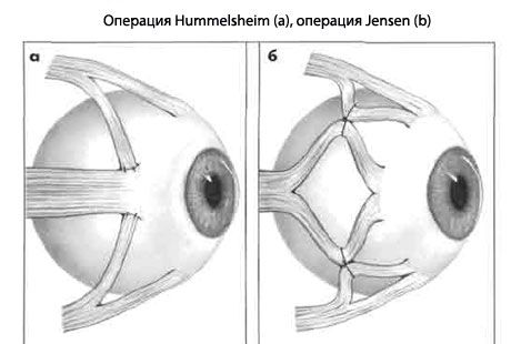 Strabismus - operatsioon