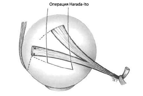 Strabismus - operatsioon