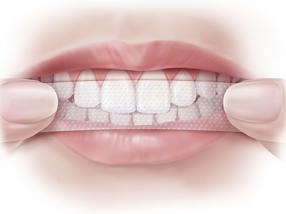Kuidas kasutada hammaste valgendamisribasid?