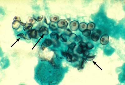 Pneumoosüstiin (Pneumocystis jiroveci) põhjustav aine