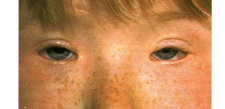 Blefarofimoosi sündroom.  Kahepoolne opereeritud ptoos, telekantus ja blefarofimoos