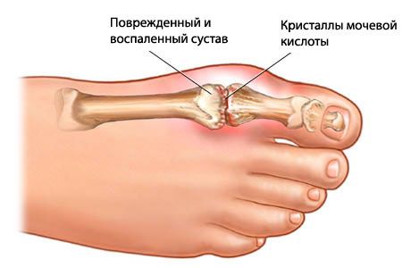 Podagra manustamismaterjalide alatooniline staadium